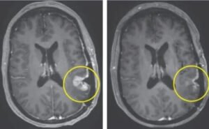 Terapi CAR T, Lima Hari Tumor Menyusut