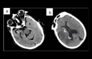 Peran CT-Scan Dalam Diagnosis Stroke Iskemik Dini